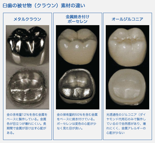 臼歯の被せ物（クラウン）素材の違い