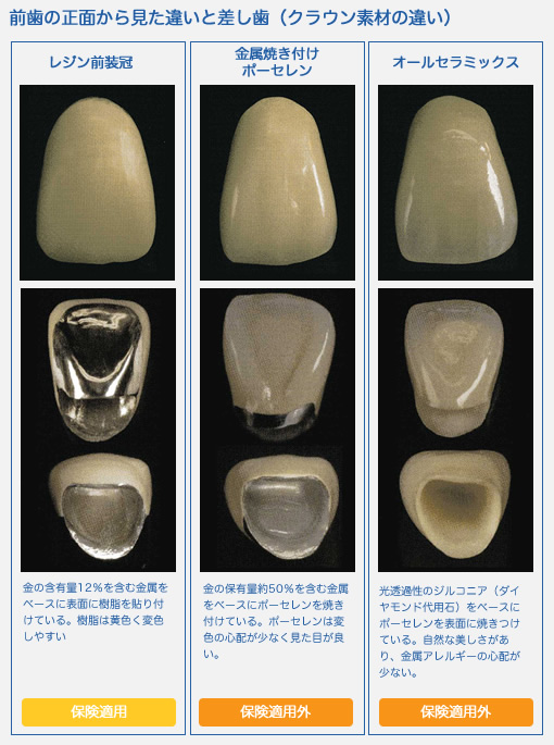 前歯の正面から見た違いと差し歯