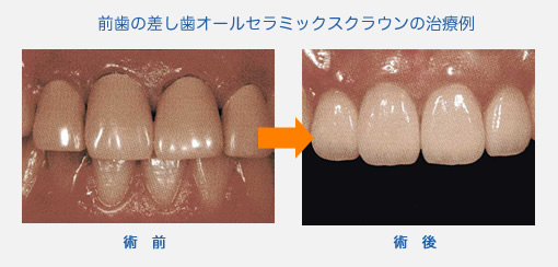 前歯の差し歯オールセラミックスクラウンの治療例
